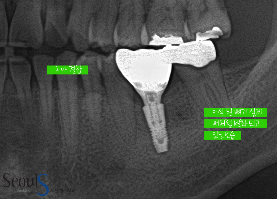 bone_implant (16)