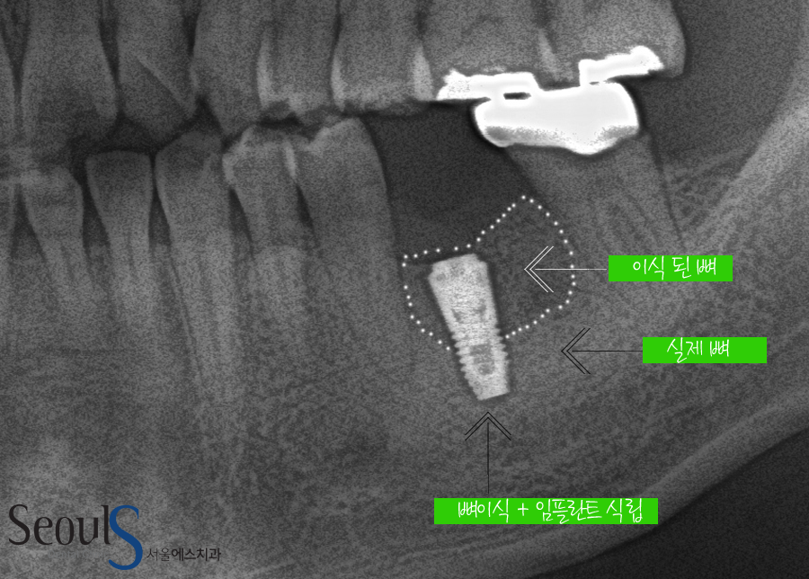 bone_implant (8)