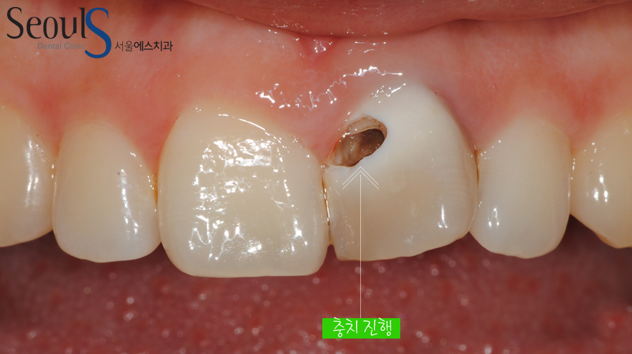 apni_implant (1)