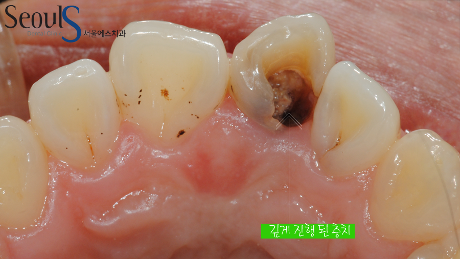 apni_implant (2)