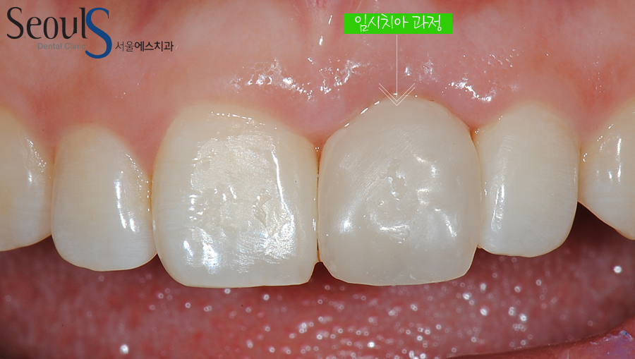 apni_implant (4)