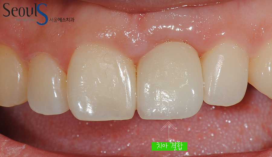 apni_implant (5)