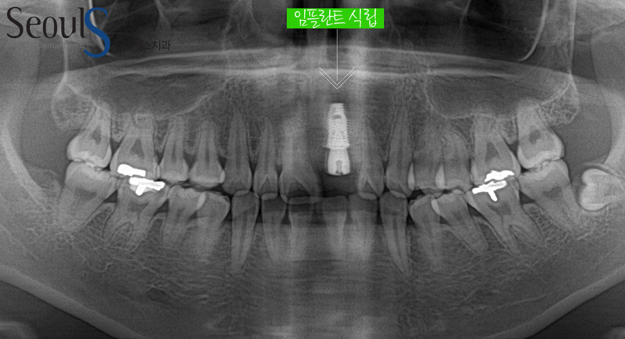 apni_implant (6)
