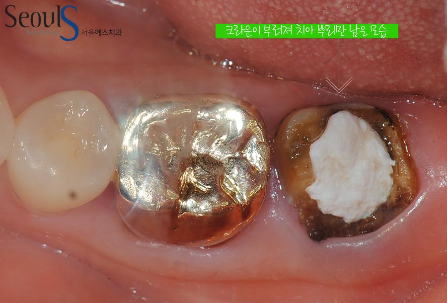 balchi_implant (1)