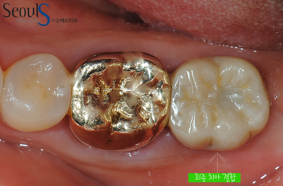 balchi_implant (10)
