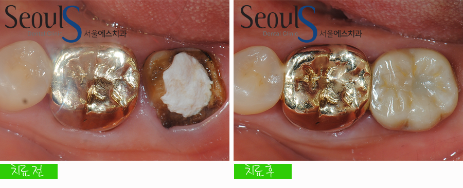 balchi_implant (11)