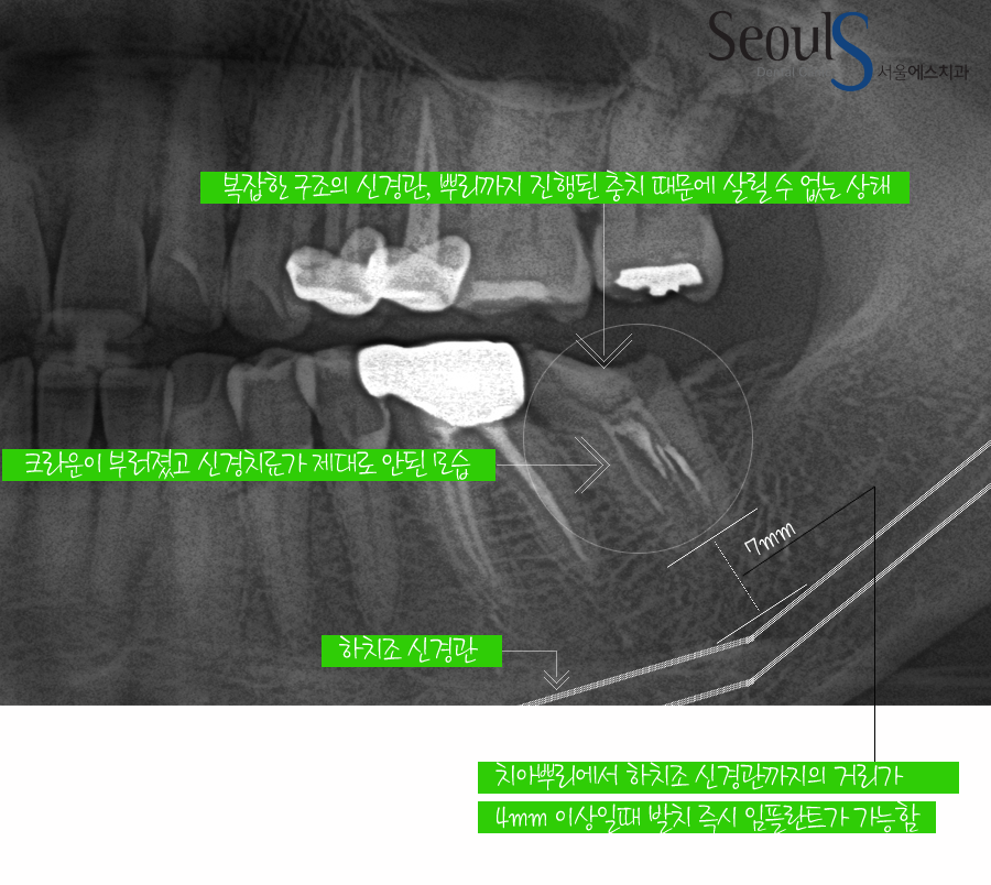 balchi_implant (2)