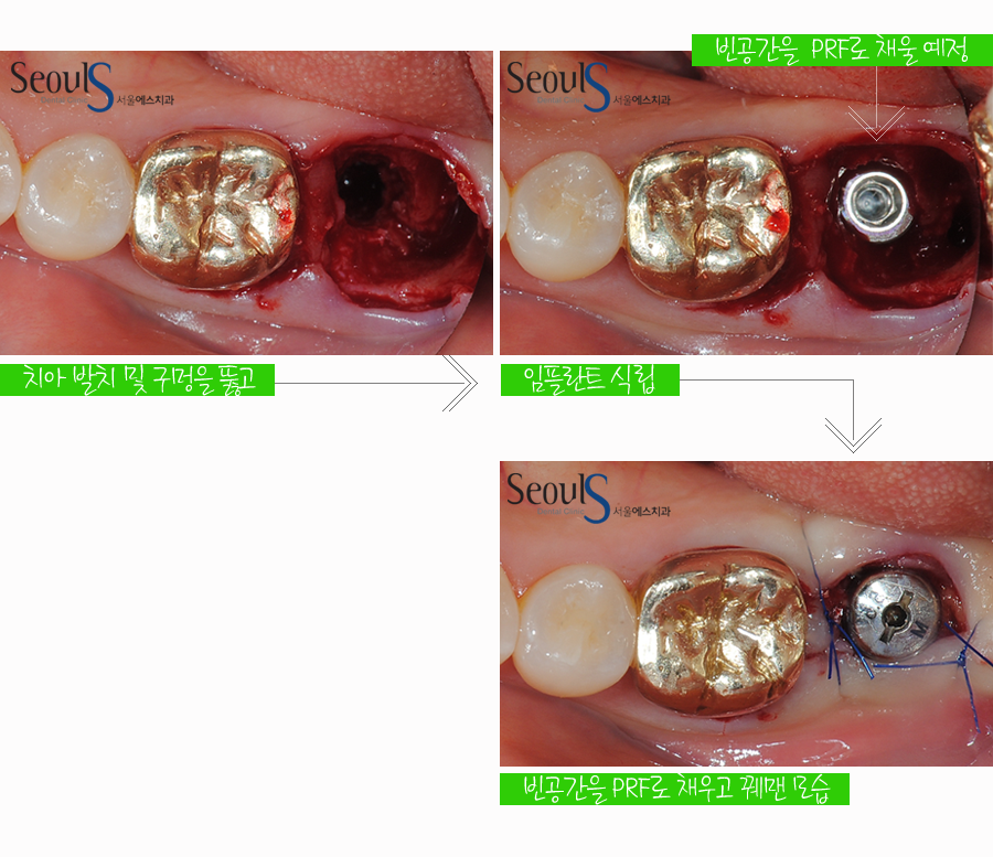balchi_implant (3)