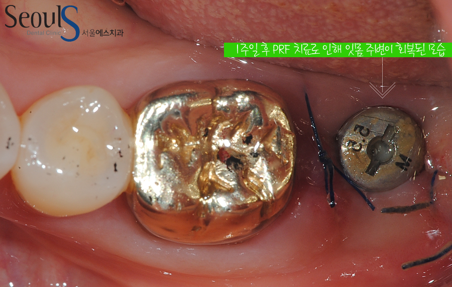 balchi_implant (4)