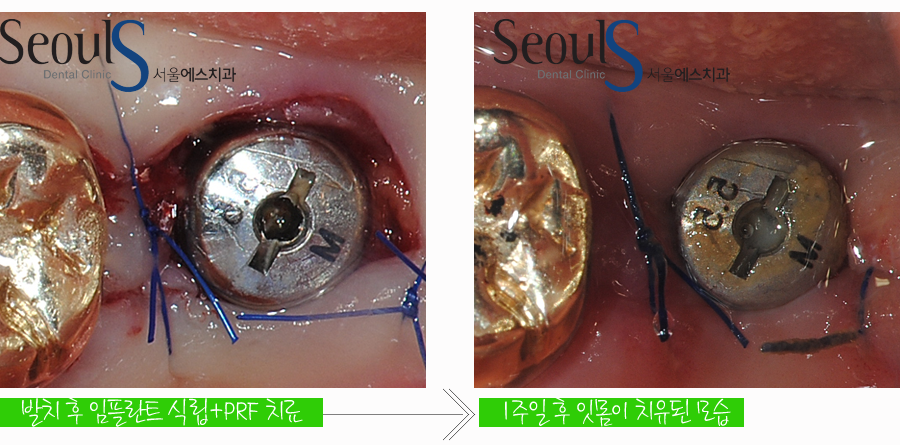 balchi_implant (5)