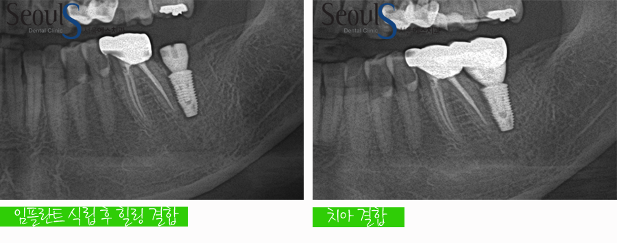 balchi_implant (6)
