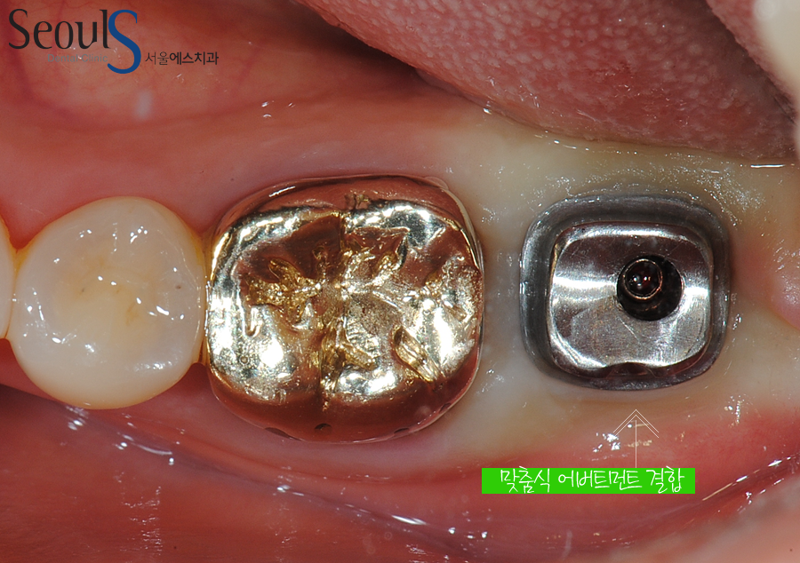 balchi_implant (7)