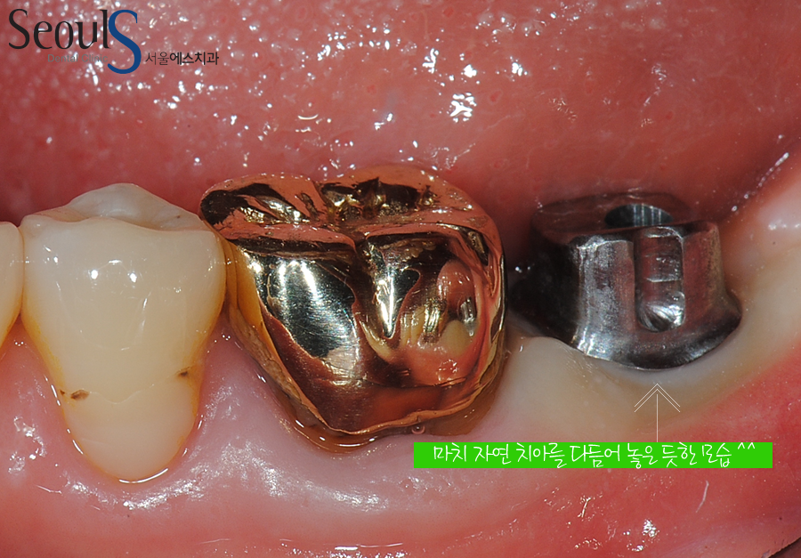 balchi_implant (8)