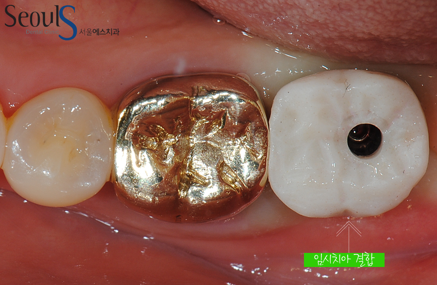 balchi_implant (9)