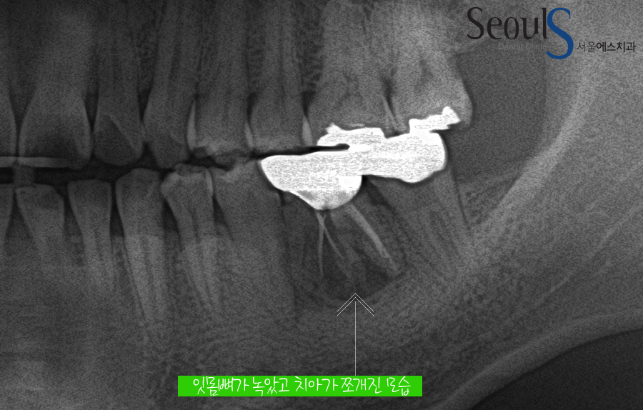bone_implant (1)