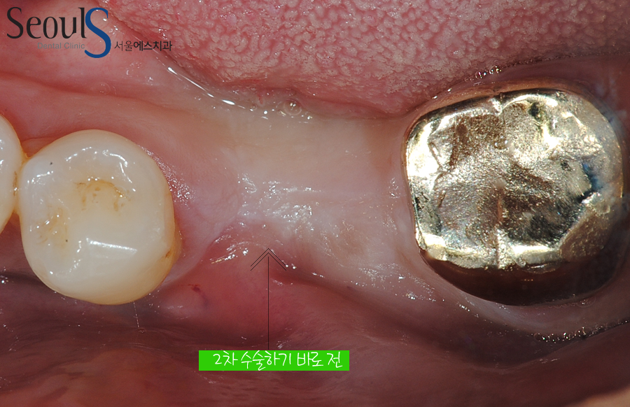 bone_implant (10)