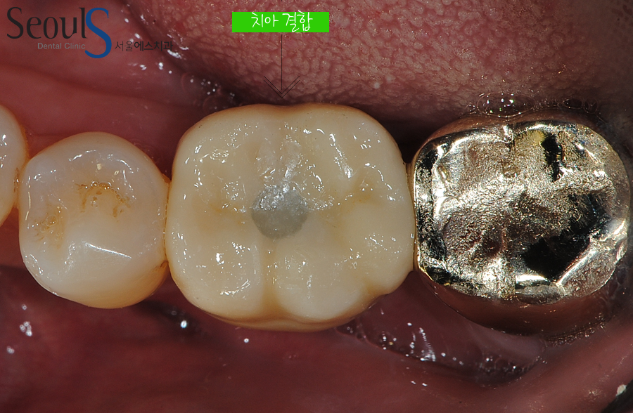 bone_implant (14)