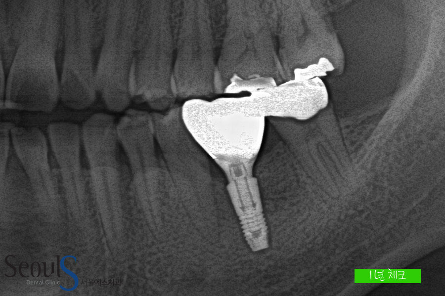 bone_implant (17)
