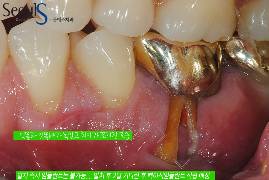 bone_implant (2)