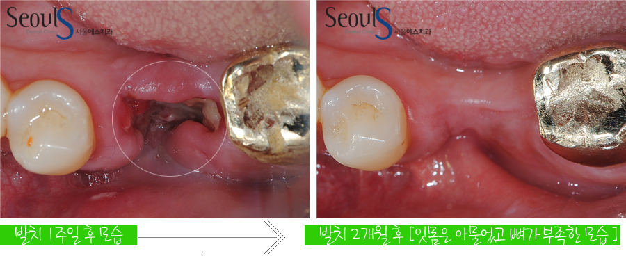 bone_implant (3)