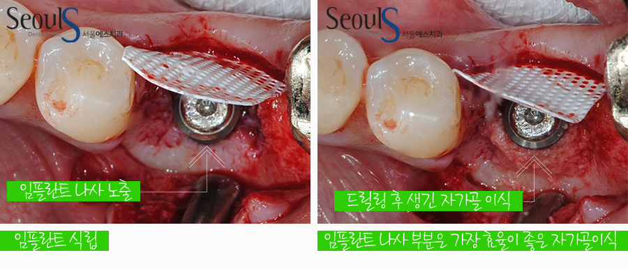 bone_implant (4)
