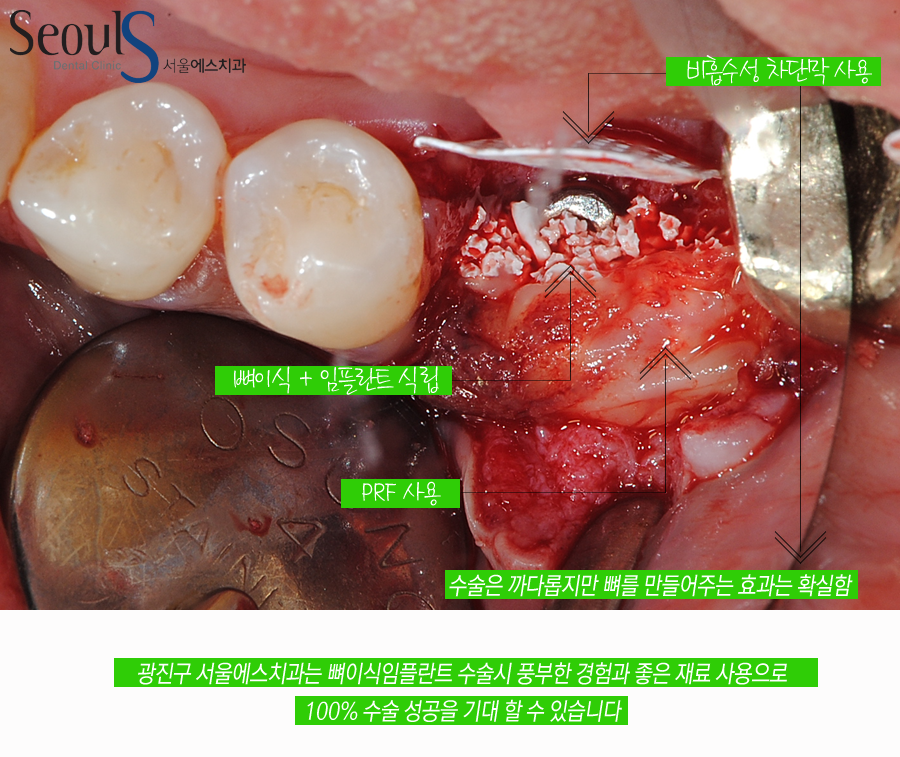 bone_implant (5)