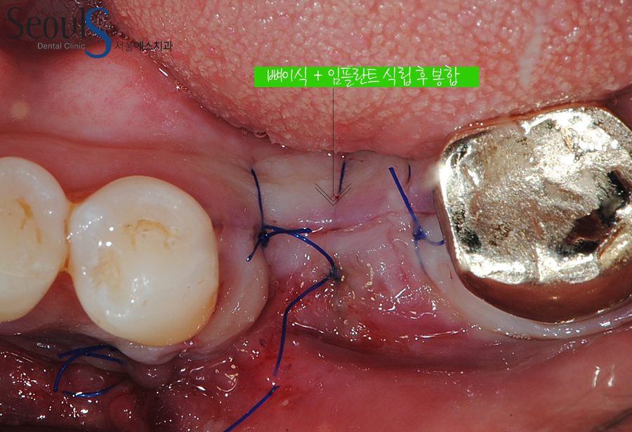 bone_implant (6)
