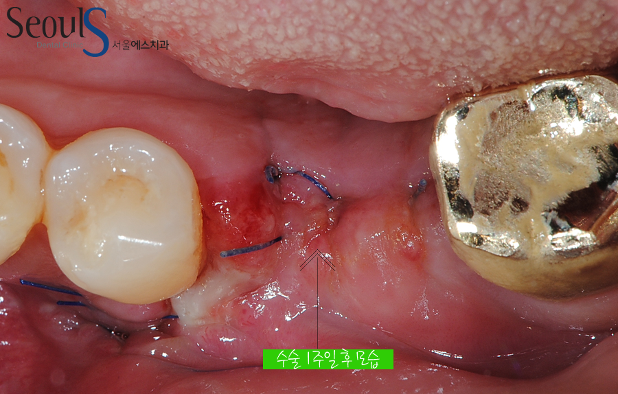 bone_implant (7)