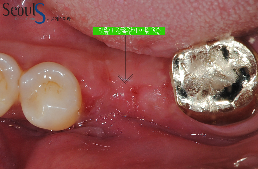 bone_implant (9)