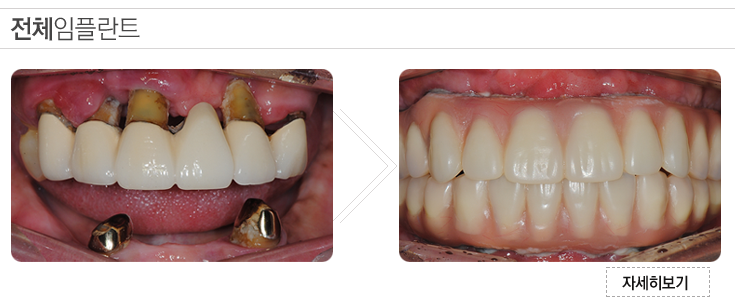submenu2_implant_01