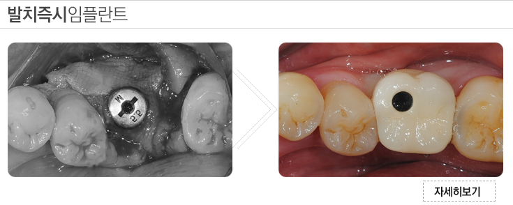 submenu2_implant_02