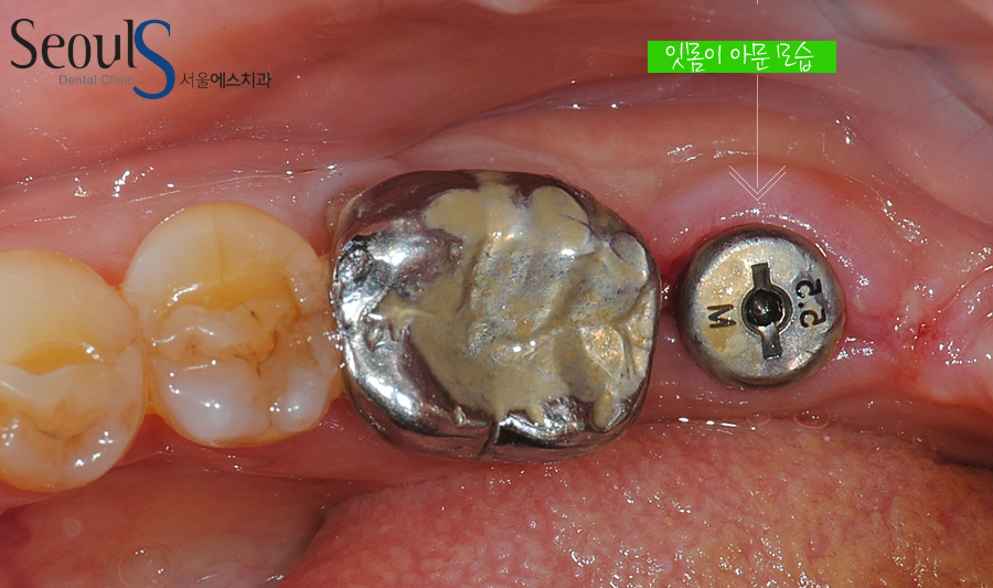 implant20160613 (2)