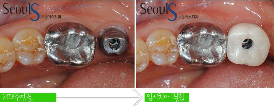 implant20160613 (6)
