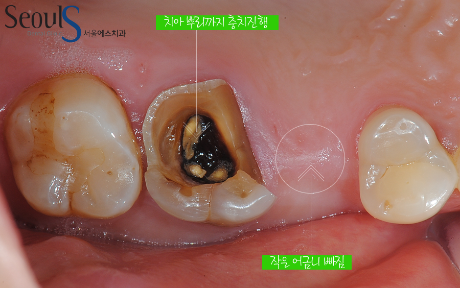 implant20160615 balchi (2)