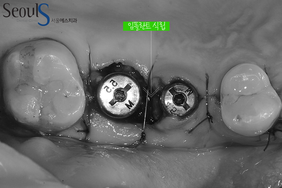 implant20160615 balchi (3)