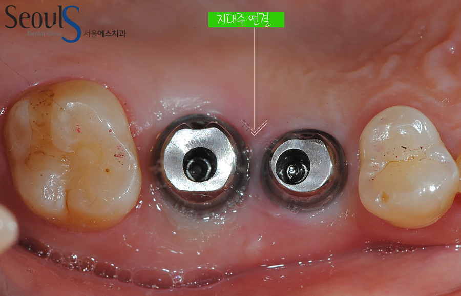 implant20160615 balchi (4)
