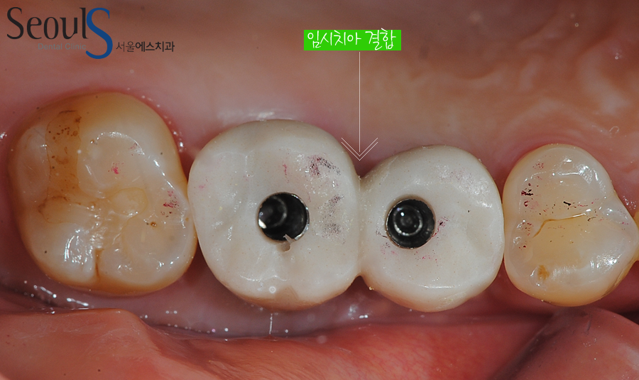 implant20160615 balchi (5)