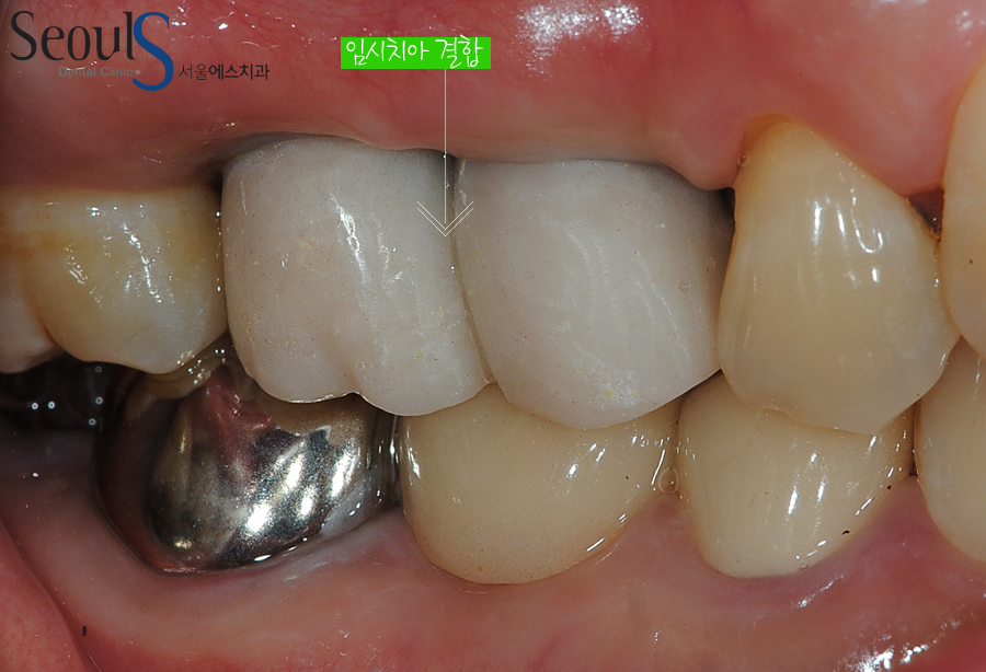 implant20160615 balchi (6)