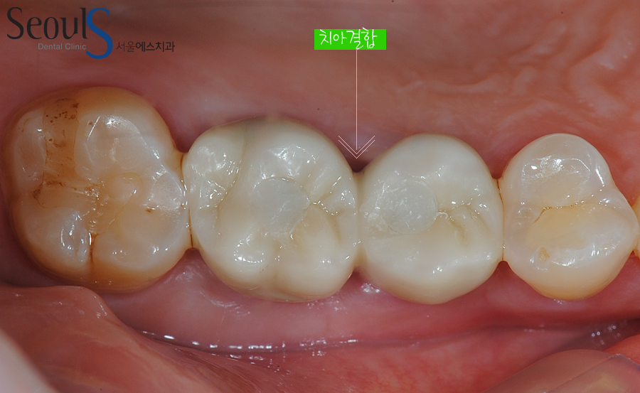 implant20160615 balchi (7)