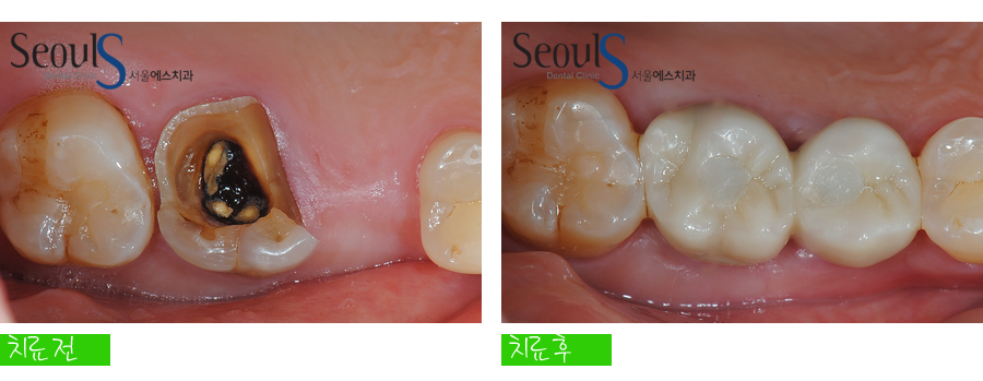 implant20160615 balchi (8)