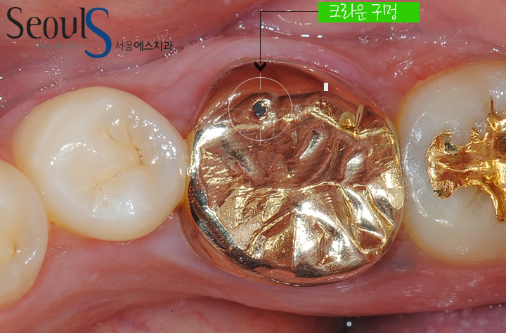 20161122_recrown-1