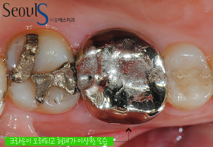 20161122_recrown-11