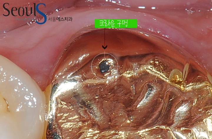 20161122_recrown-2