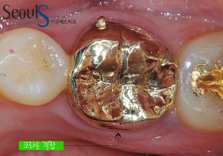 20161122_recrown-5