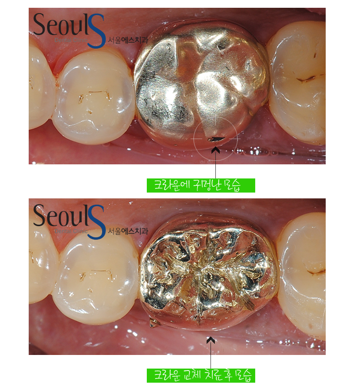 20161122_recrown-7