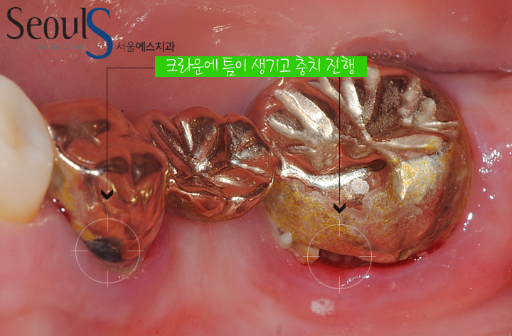 20161122_recrown-8