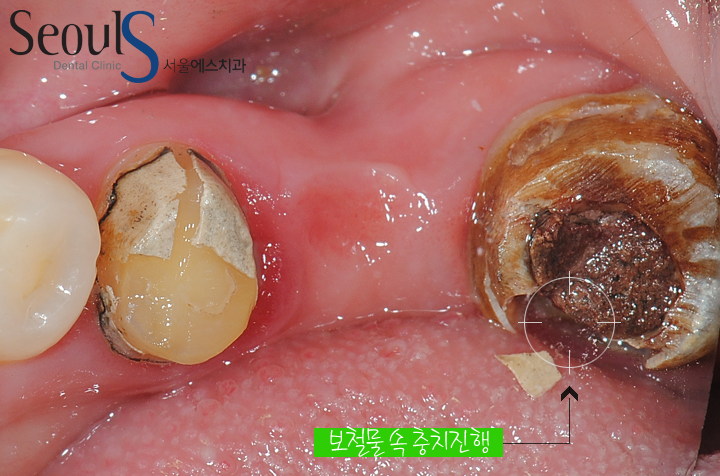 20161122_recrown-9