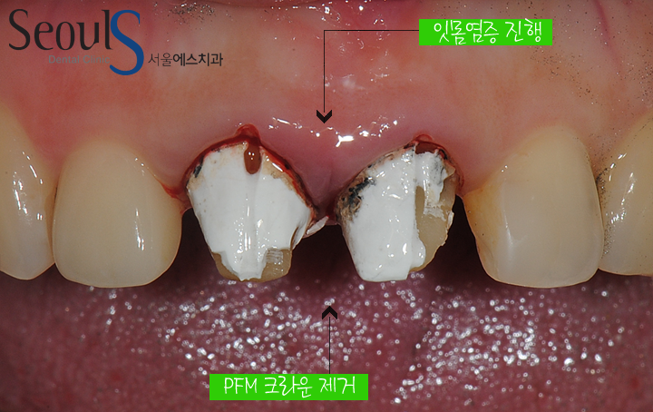 20170126-allcera (4)